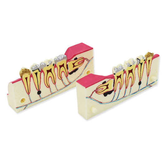 Dental Teeth Model,Transparent Dental Implant Teeth Model Dentist Standard Disease Removable Tooth Pathological Teaching Model(D-WD)