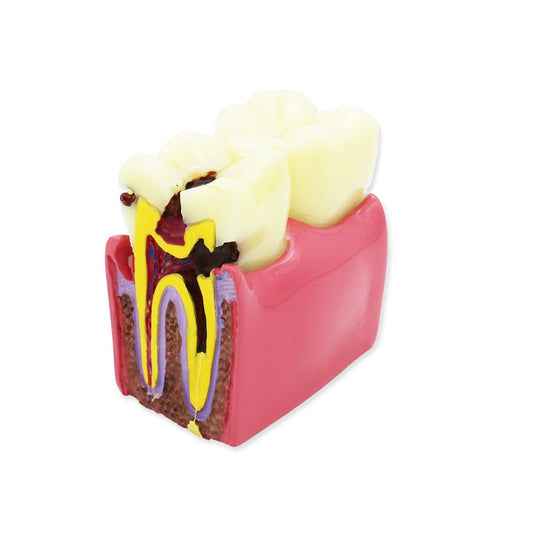 Dental Teeth Model,Transparent Dental Implant Teeth Model Dentist Standard Disease Removable Tooth Pathological Teaching Model(D-CA)