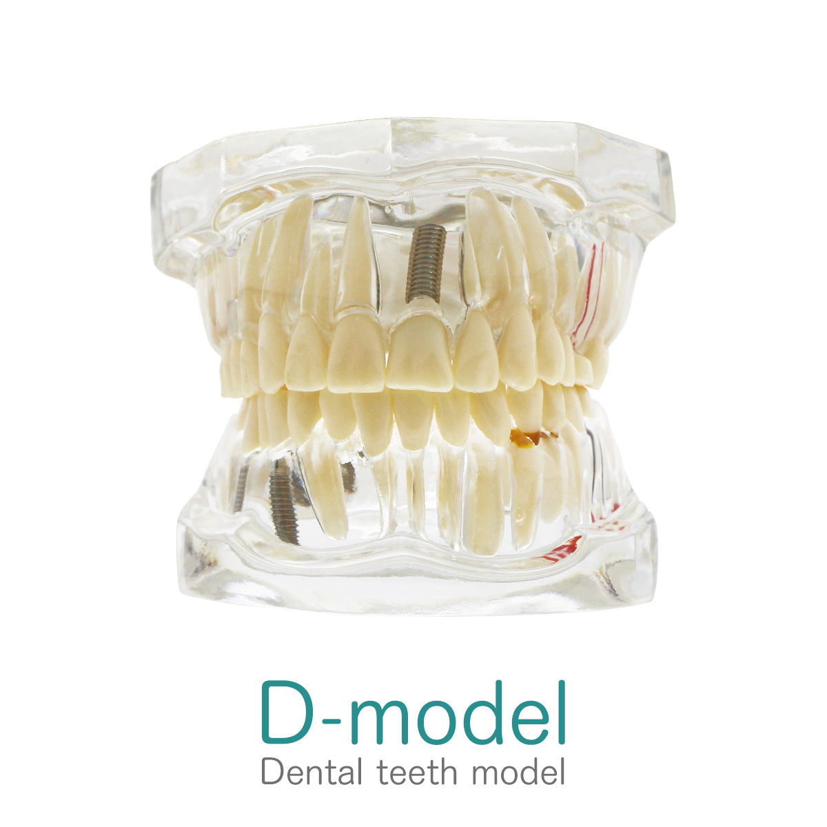 Transparent Disease Teeth Model, YOUYA DENTAL Transparent Dental Implant Teeth Model Dentist Standard Disease Removable Tooth Pathological Teaching Model