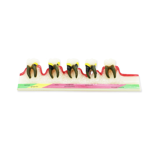 Dental Teeth Model,Transparent Dental Implant Teeth Model Dentist Standard Disease Removable Tooth Pathological Teaching Model(D-PE)