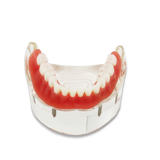 D-DT(Mandibular)Dental Teeth Model,Transparent Dental Implant Teeth Model Dentist Standard Disease Removable Tooth Pathological Teaching Model