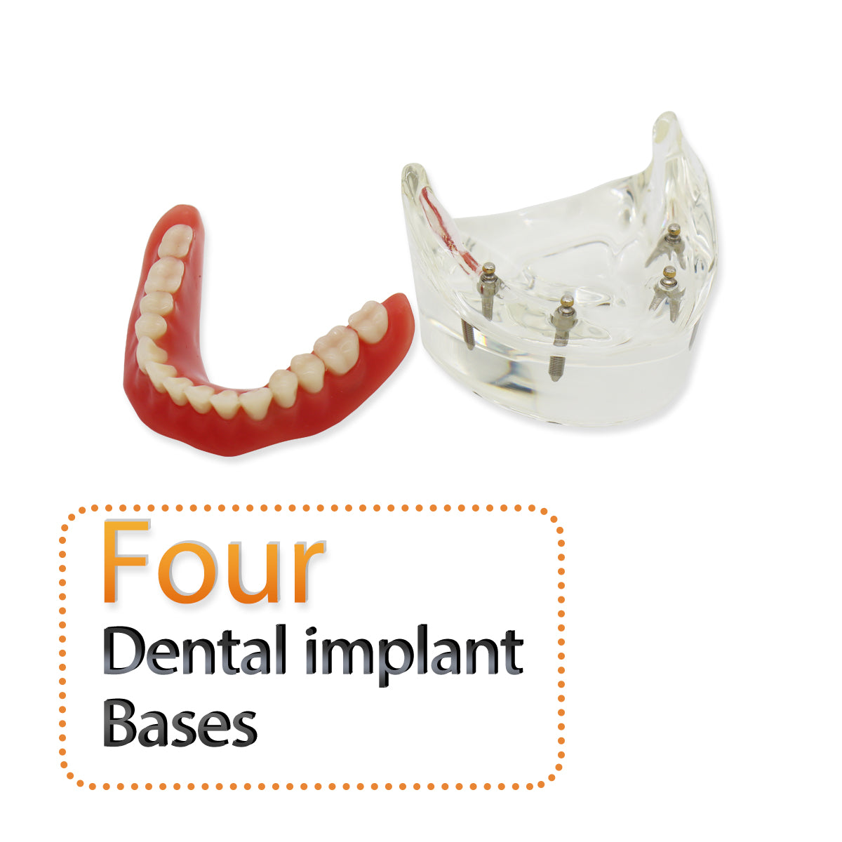 D-DT(Mandibular)Dental Teeth Model,Transparent Dental Implant Teeth Model Dentist Standard Disease Removable Tooth Pathological Teaching Model