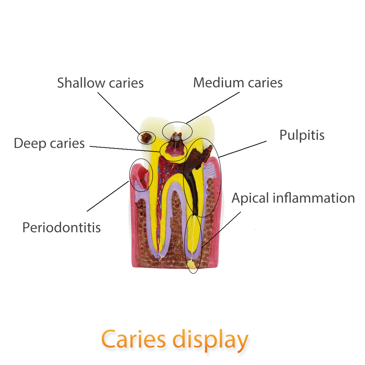 Dental Teeth Model,Transparent Dental Implant Teeth Model Dentist Standard Disease Removable Tooth Pathological Teaching Model(D-CA)