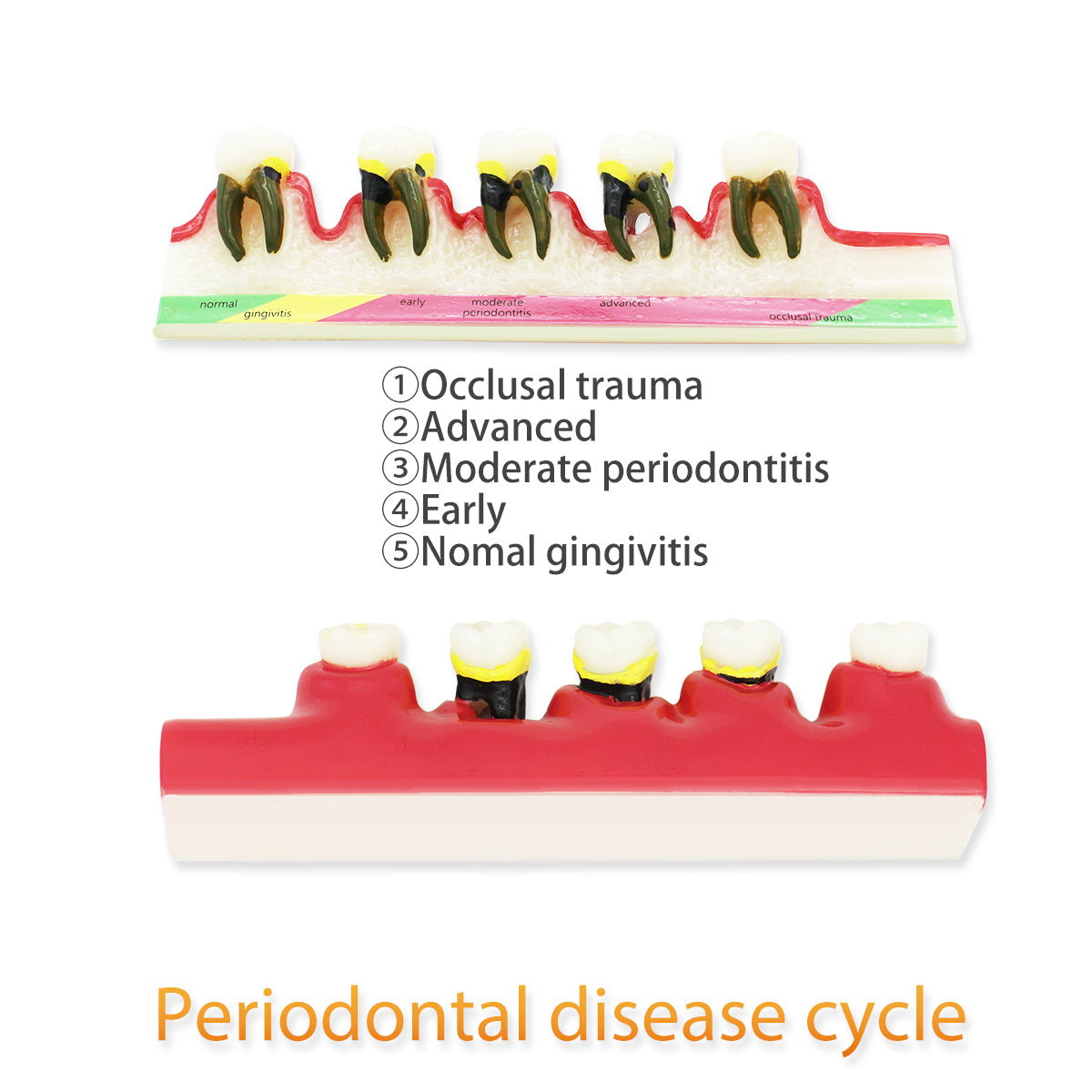Dental Teeth Model,Transparent Dental Implant Teeth Model Dentist Standard Disease Removable Tooth Pathological Teaching Model(D-PE)