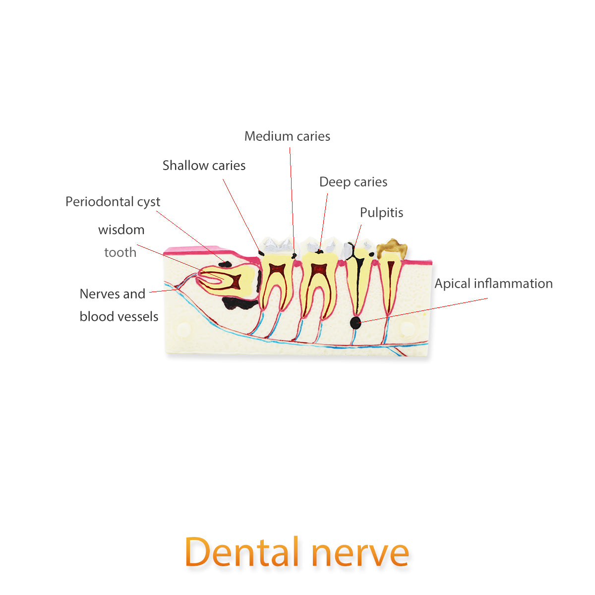 Dental Teeth Model,Transparent Dental Implant Teeth Model Dentist Standard Disease Removable Tooth Pathological Teaching Model(D-WD)
