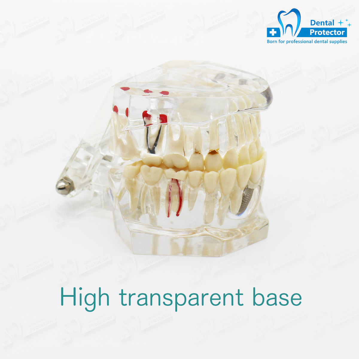 Transparent Disease Teeth Model, YOUYA DENTAL Transparent Dental Implant Teeth Model Dentist Standard Disease Removable Tooth Pathological Teaching Model