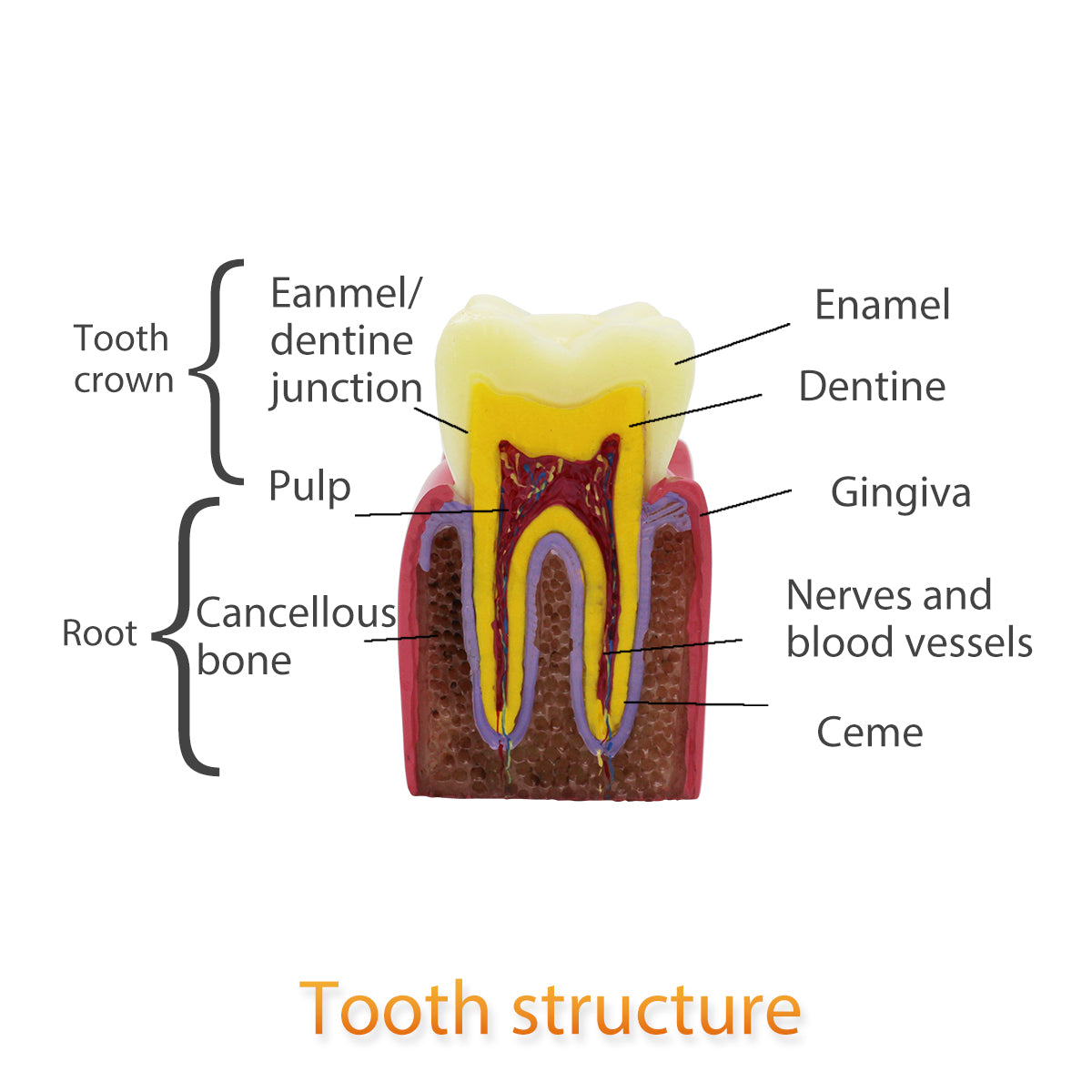 Dental Teeth Model,Transparent Dental Implant Teeth Model Dentist Standard Disease Removable Tooth Pathological Teaching Model(D-CA)