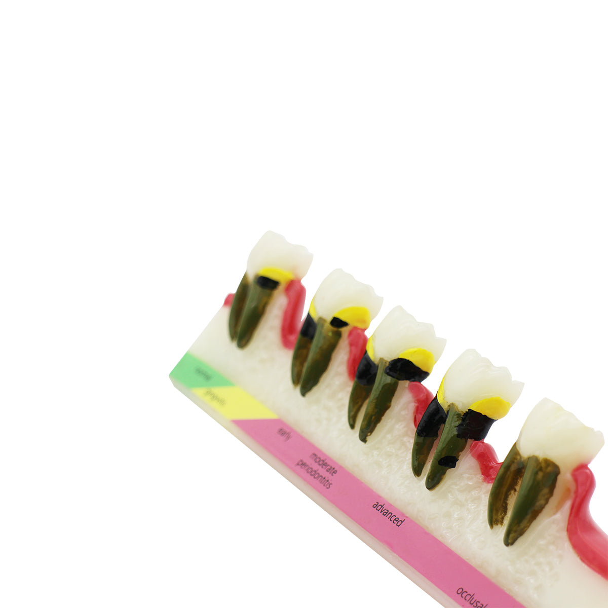 Dental Teeth Model,Transparent Dental Implant Teeth Model Dentist Standard Disease Removable Tooth Pathological Teaching Model(D-PE)