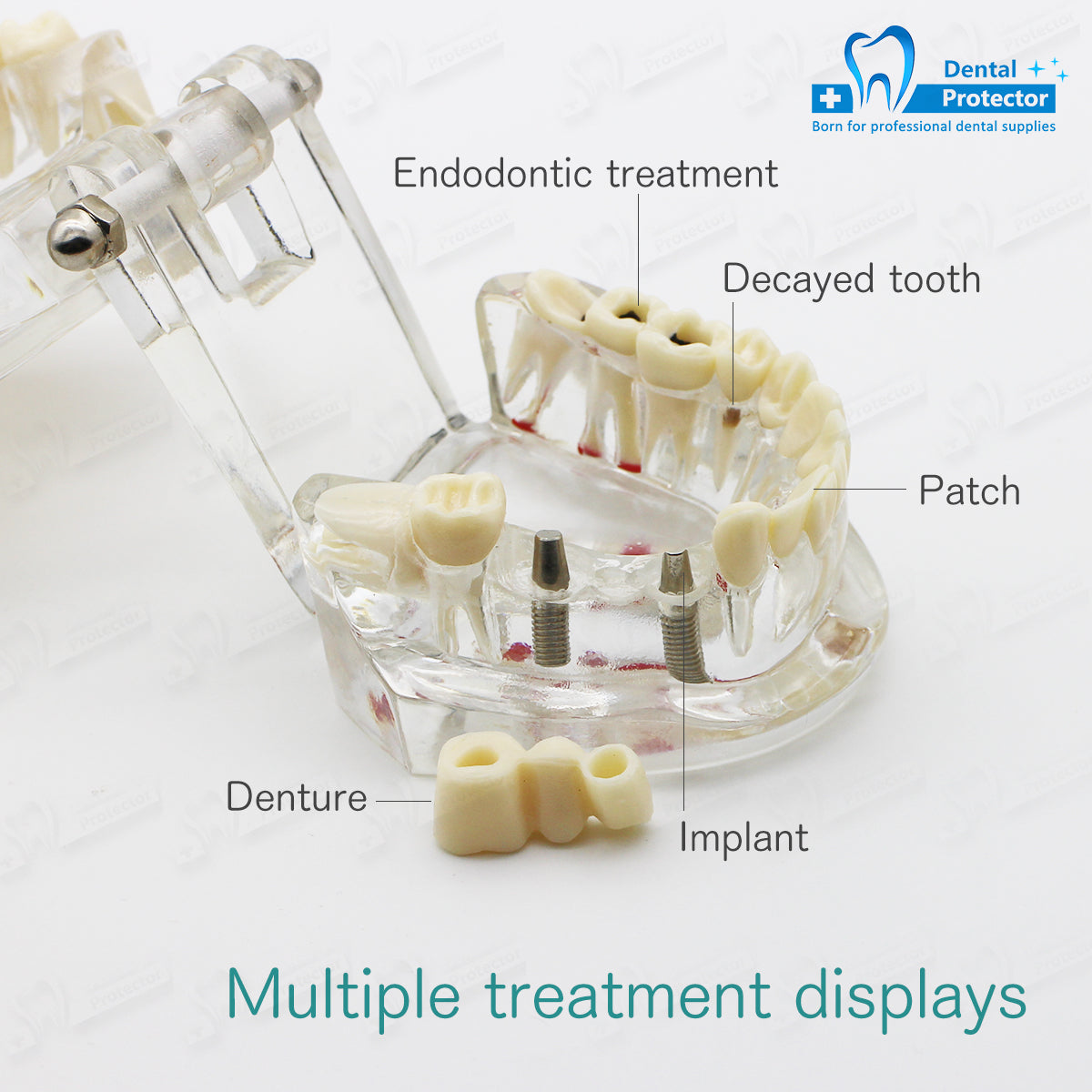 Transparent Disease Teeth Model, YOUYA DENTAL Transparent Dental Implant Teeth Model Dentist Standard Disease Removable Tooth Pathological Teaching Model