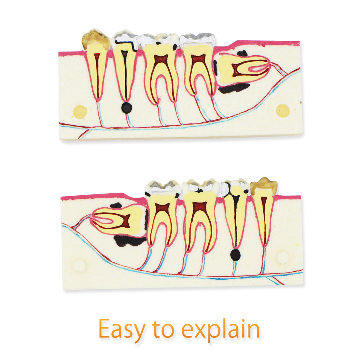 Dental Teeth Model,Transparent Dental Implant Teeth Model Dentist Standard Disease Removable Tooth Pathological Teaching Model(D-WD)