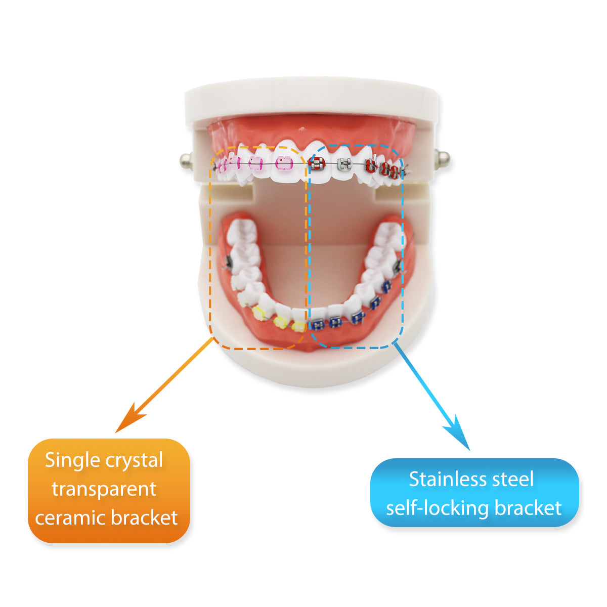 Dental Teeth Model,Transparent Dental Implant Teeth Model Dentist Standard Disease Removable Tooth Pathological Teaching Model (D-OR)