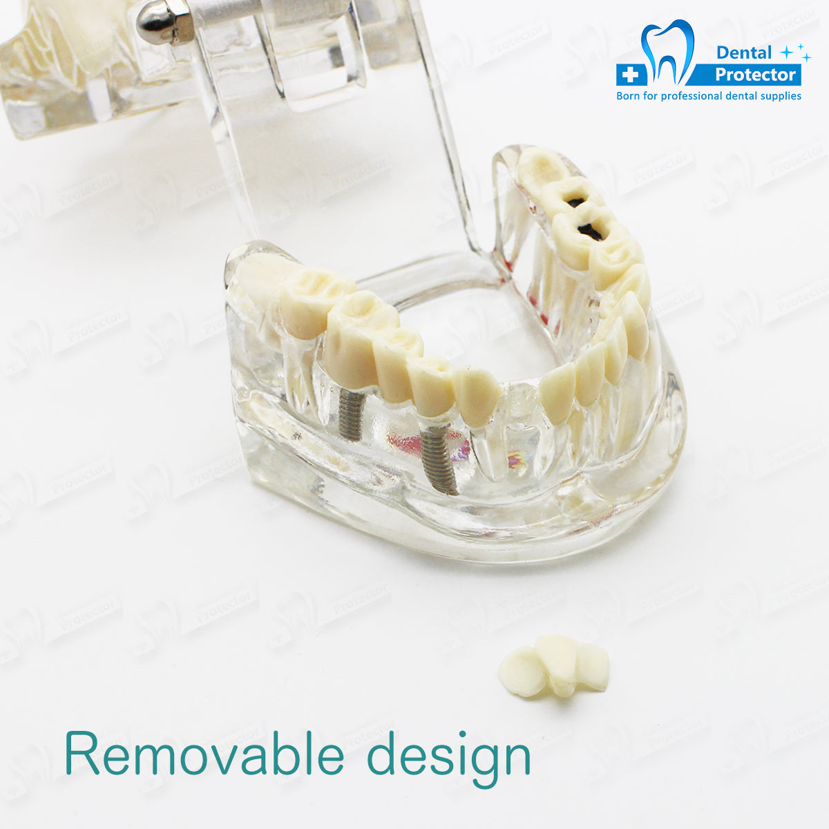 Transparent Disease Teeth Model, YOUYA DENTAL Transparent Dental Implant Teeth Model Dentist Standard Disease Removable Tooth Pathological Teaching Model