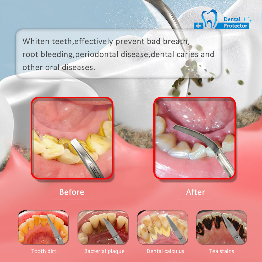 Dental Mixed Tip (P1 G1 G2 G3 G4 )scaling fit EMS,Woodpecker