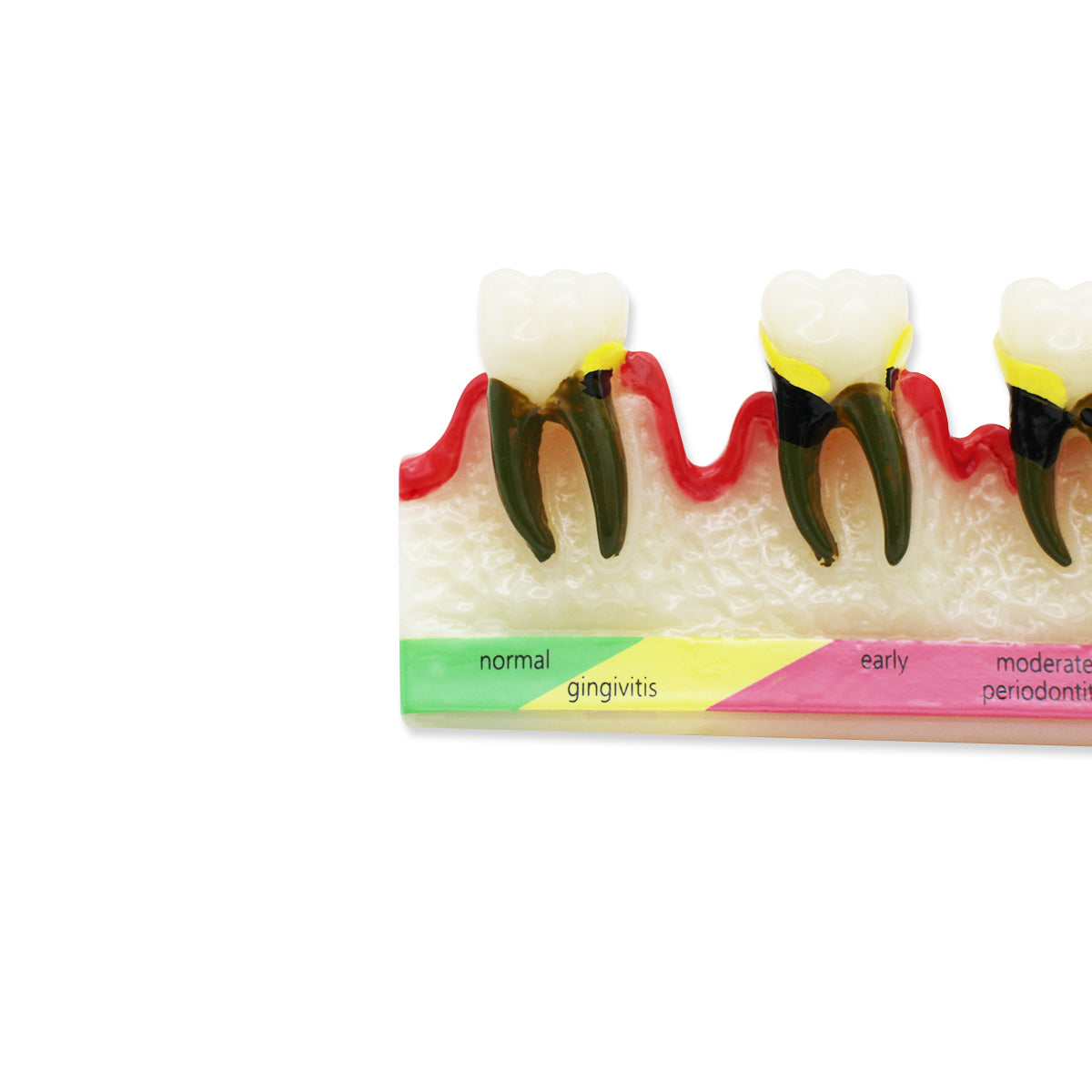 Dental Teeth Model,Transparent Dental Implant Teeth Model Dentist Standard Disease Removable Tooth Pathological Teaching Model(D-PE)