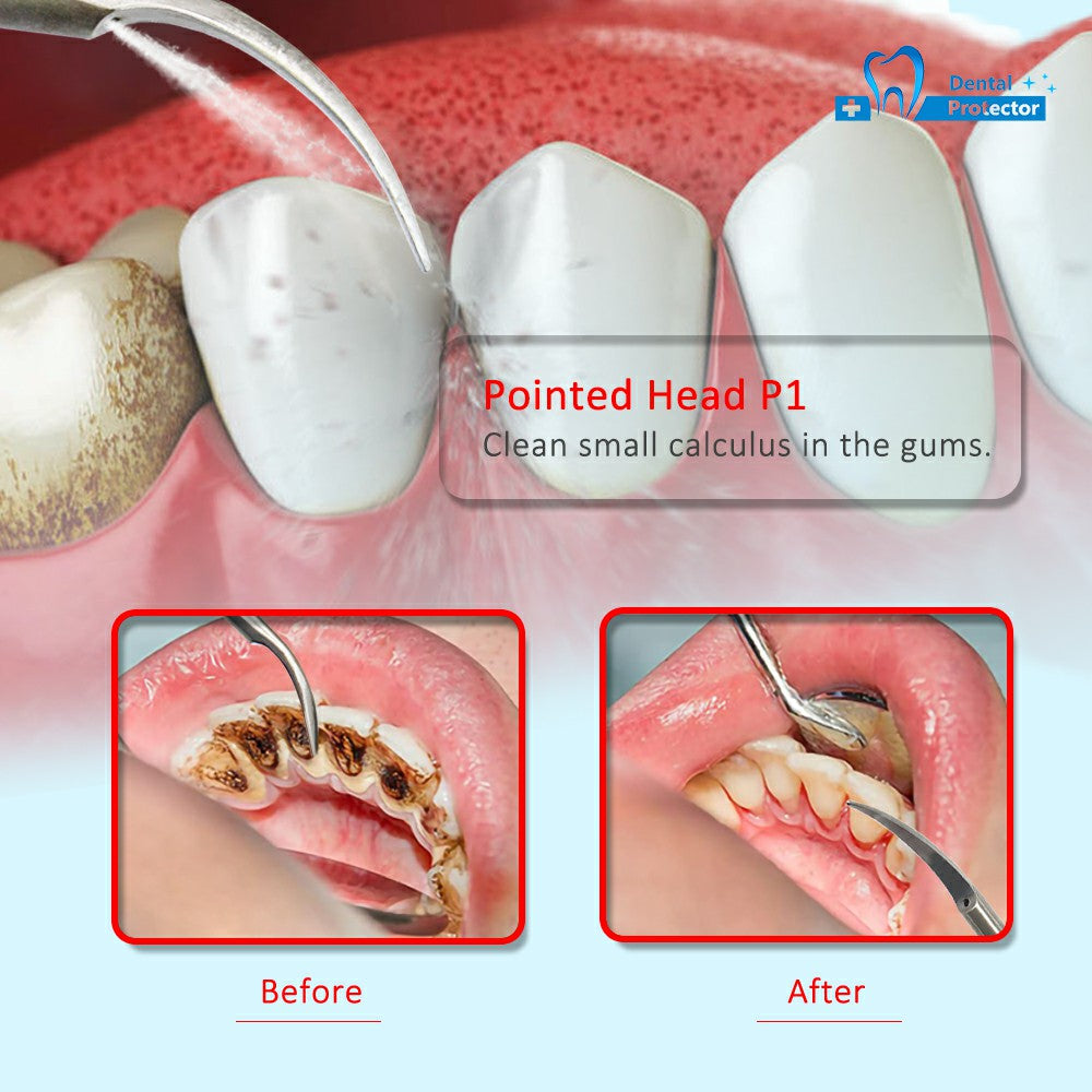 Dental Mixed Tip P1*10 scaling fit EMS ,Woodpecker