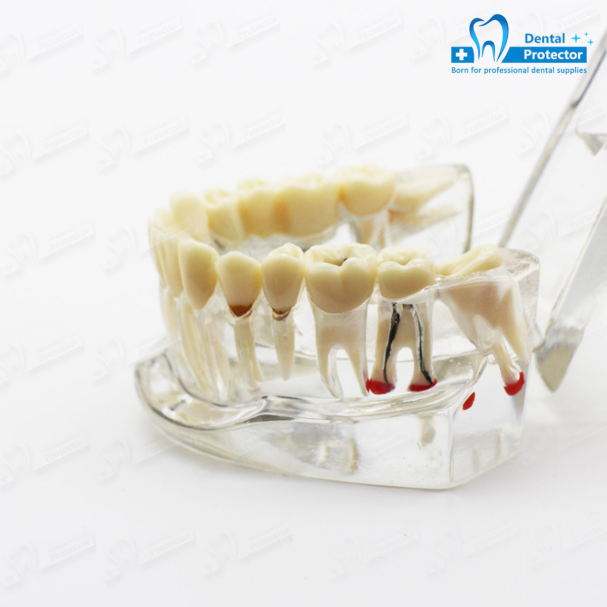 Transparent Disease Teeth Model, YOUYA DENTAL Transparent Dental Implant Teeth Model Dentist Standard Disease Removable Tooth Pathological Teaching Model