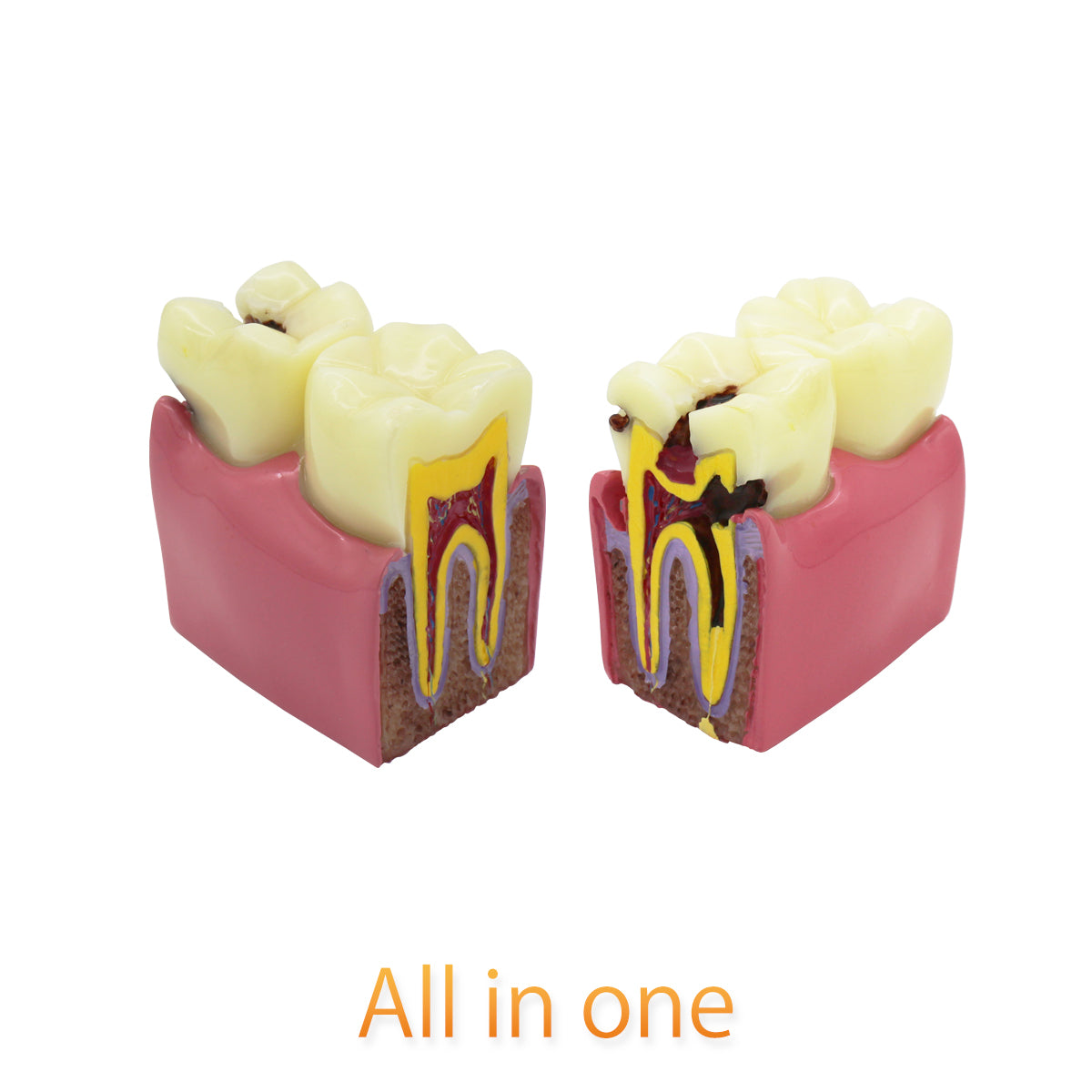 Dental Teeth Model,Transparent Dental Implant Teeth Model Dentist Standard Disease Removable Tooth Pathological Teaching Model(D-CA)