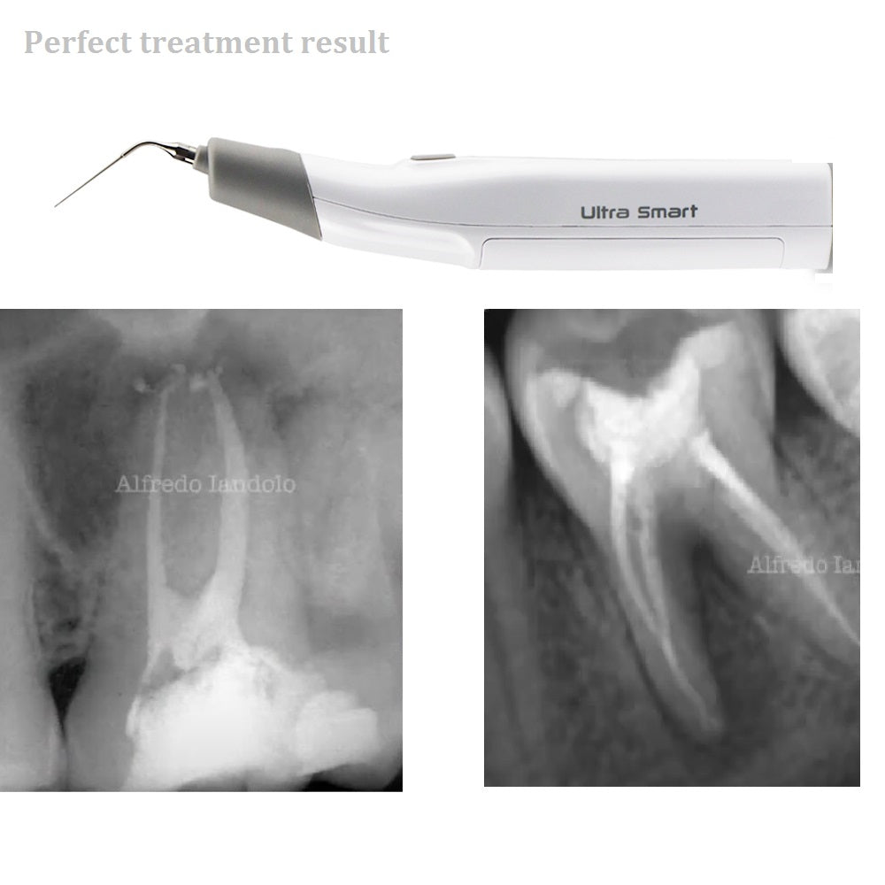 COXO Wireless Ultra Smart Endo Ultrasonic Activator with LED Light for Root Canal Treatment Gray color