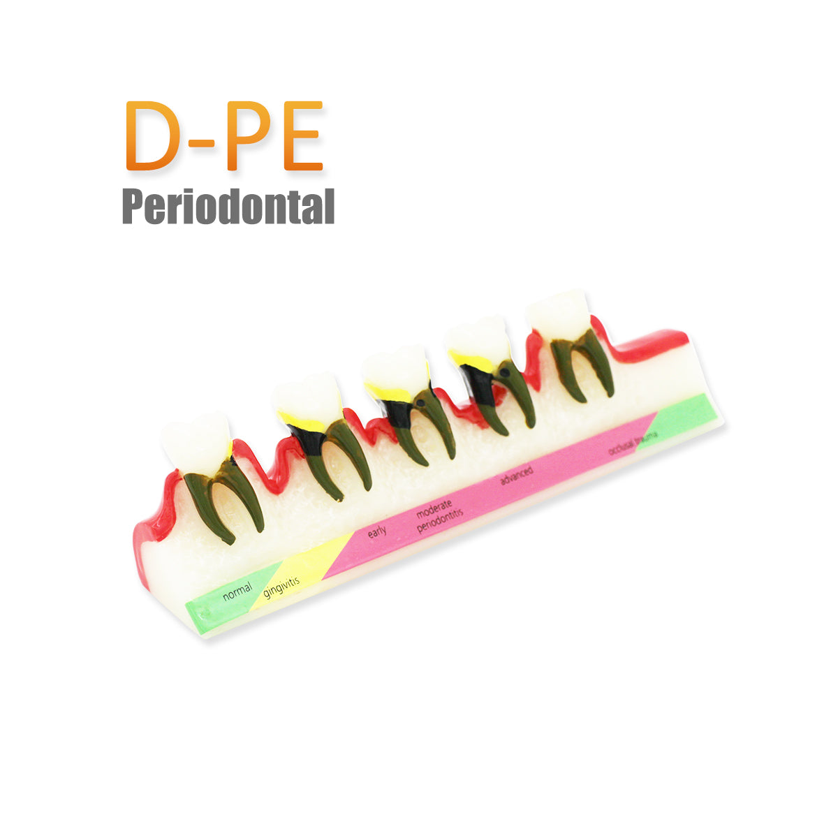 Dental Teeth Model,Transparent Dental Implant Teeth Model Dentist Standard Disease Removable Tooth Pathological Teaching Model(D-PE)
