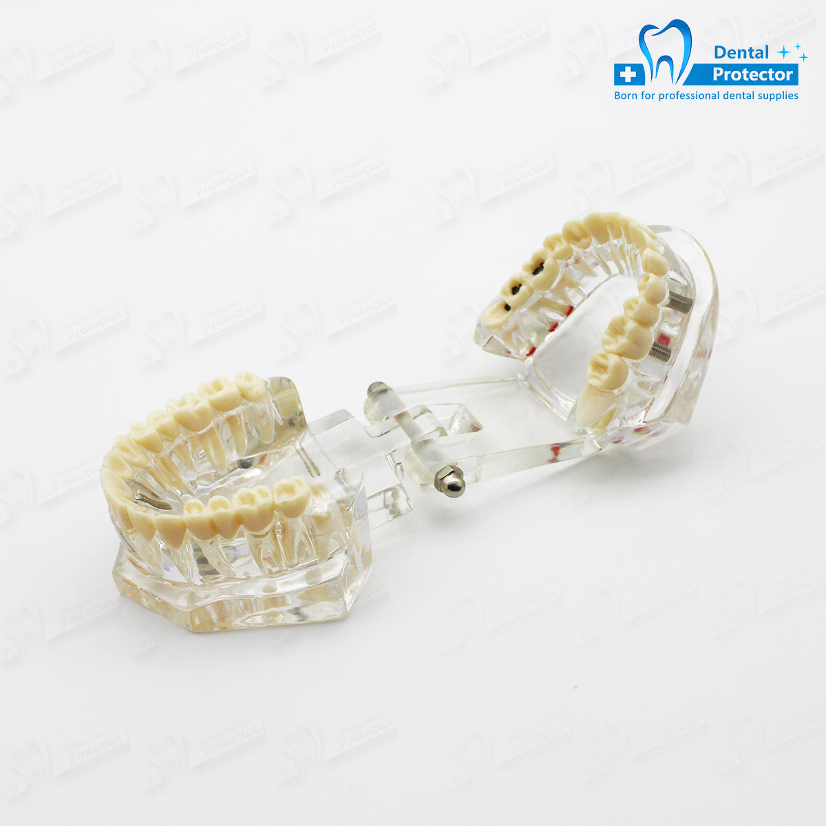 Transparent Disease Teeth Model, YOUYA DENTAL Transparent Dental Implant Teeth Model Dentist Standard Disease Removable Tooth Pathological Teaching Model