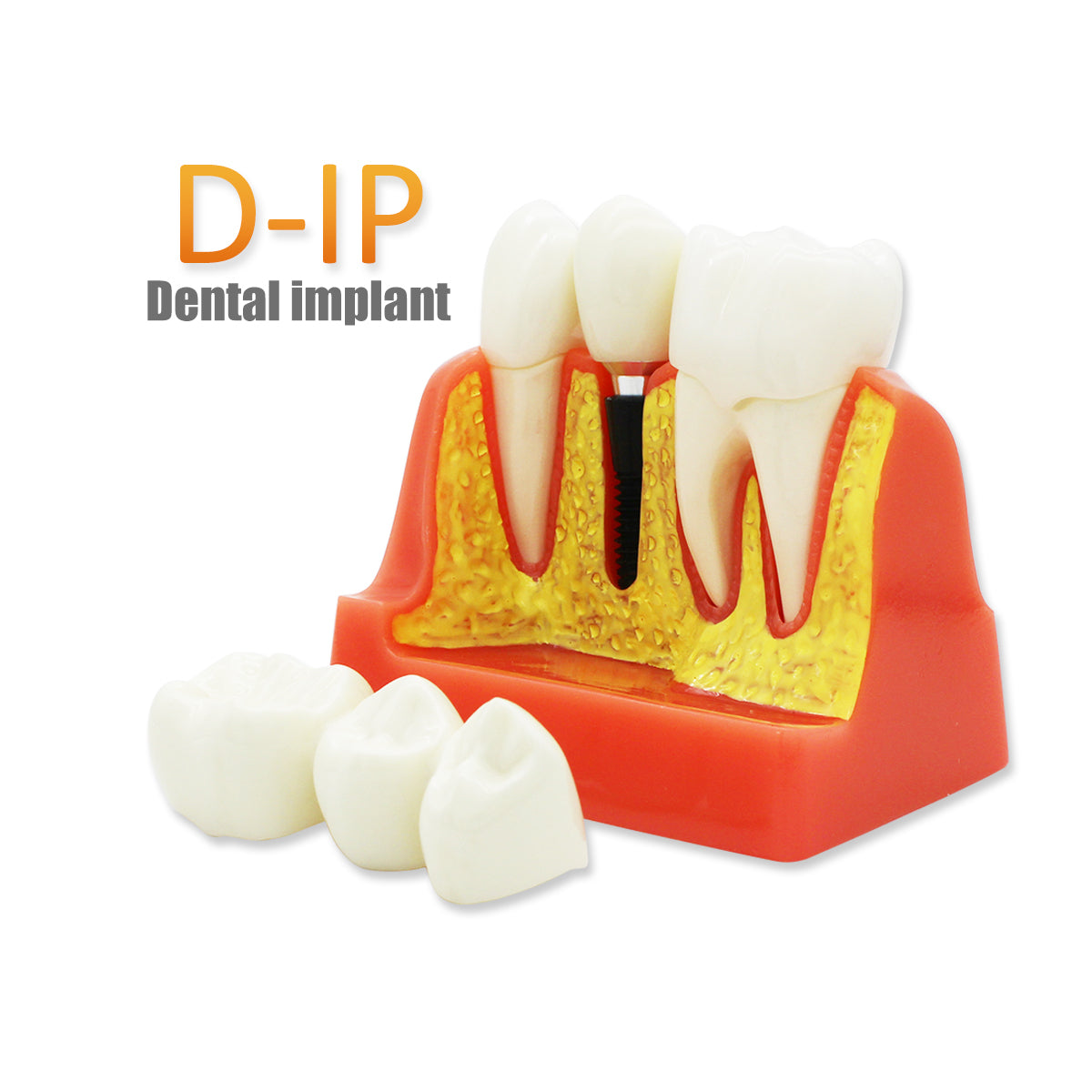 Dental Teeth Model,Transparent Dental Implant Teeth Model Dentist Standard Disease Removable Tooth Pathological Teaching Model(D-IP)