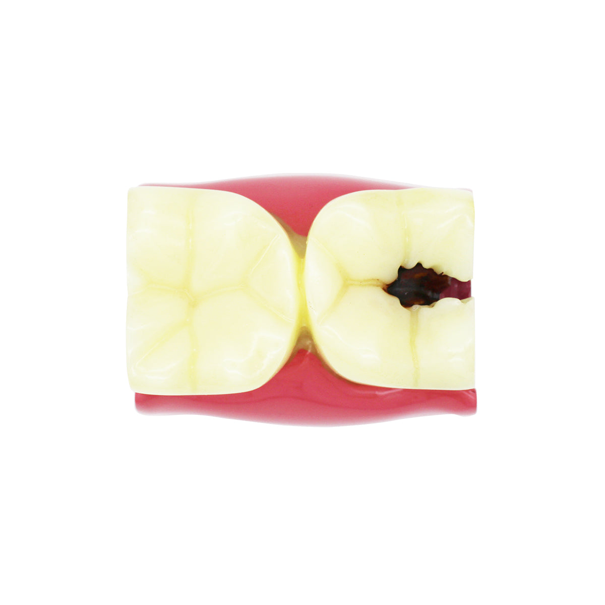 Dental Teeth Model,Transparent Dental Implant Teeth Model Dentist Standard Disease Removable Tooth Pathological Teaching Model(D-CA)