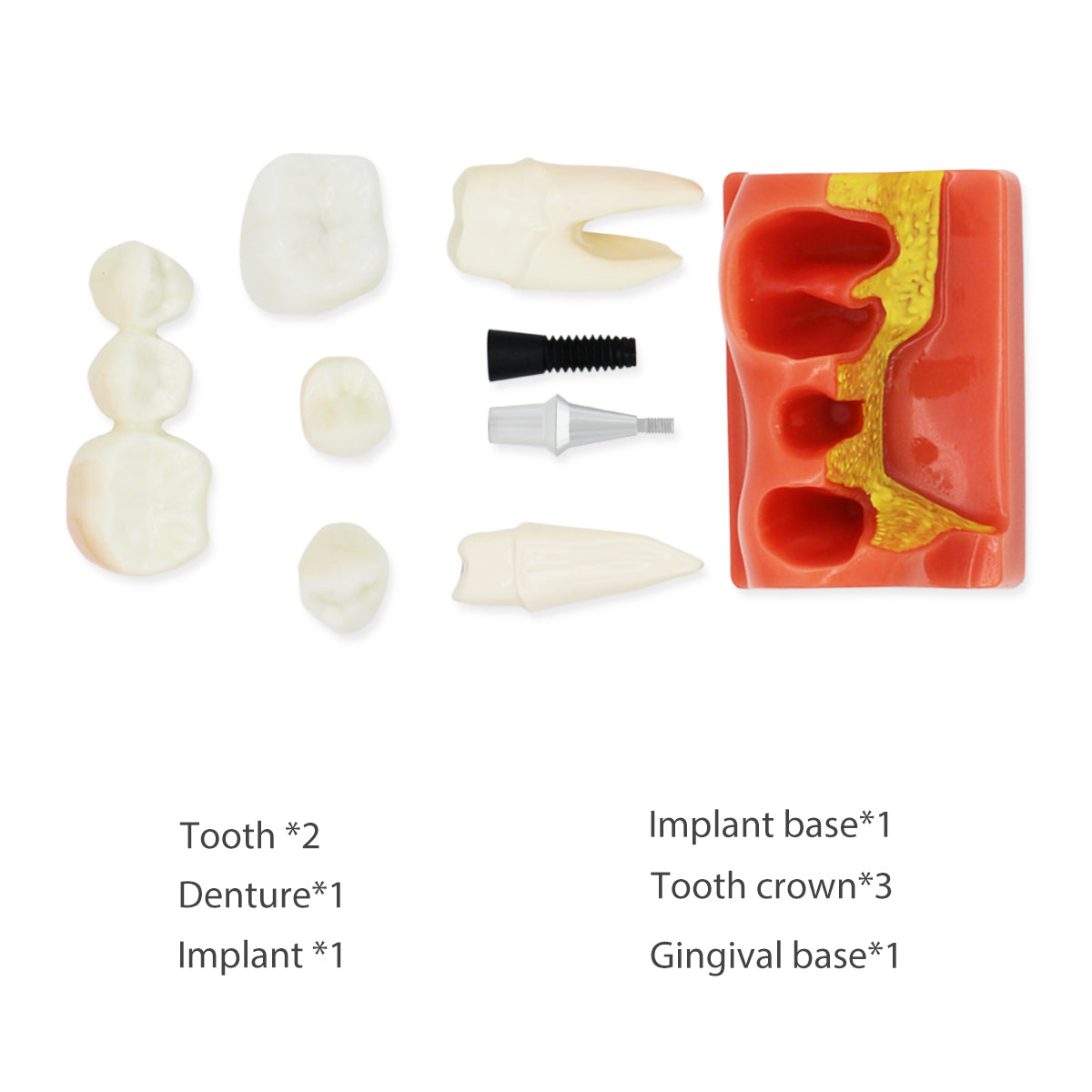 Dental Teeth Model,Transparent Dental Implant Teeth Model Dentist Standard Disease Removable Tooth Pathological Teaching Model(D-IP)