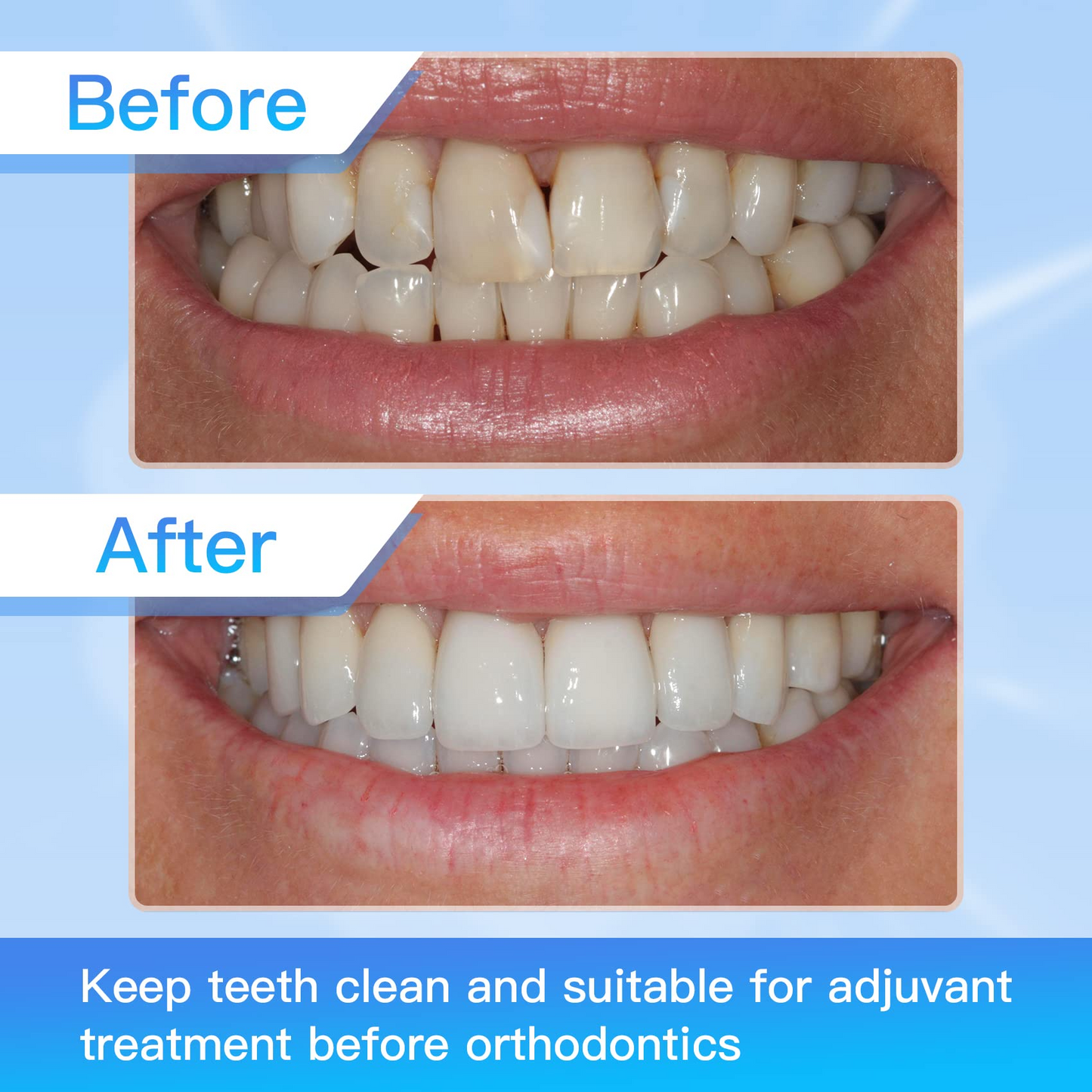 DM-PS Dental Metal Polishing Strips Double Side 12 PCS, Stainless Finishing Strips Teeth Abraive 4mm x 6M, Cleaning Tools for Oral Care & Inter-Dental - Sanding Grinding Teeth