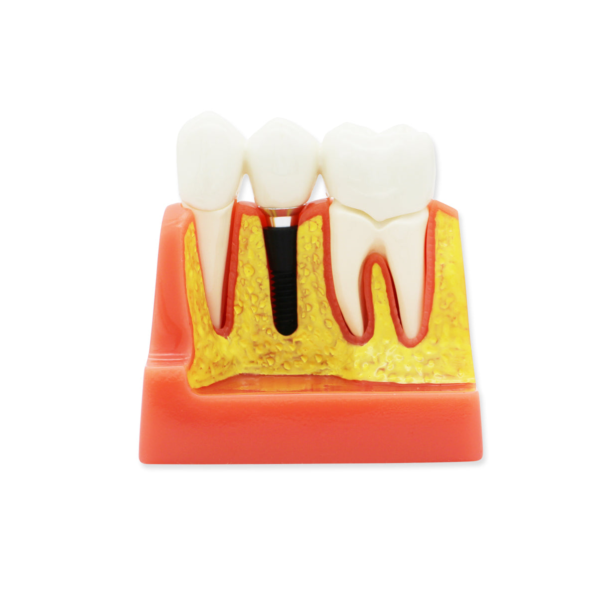 Dental Teeth Model,Transparent Dental Implant Teeth Model Dentist Standard Disease Removable Tooth Pathological Teaching Model