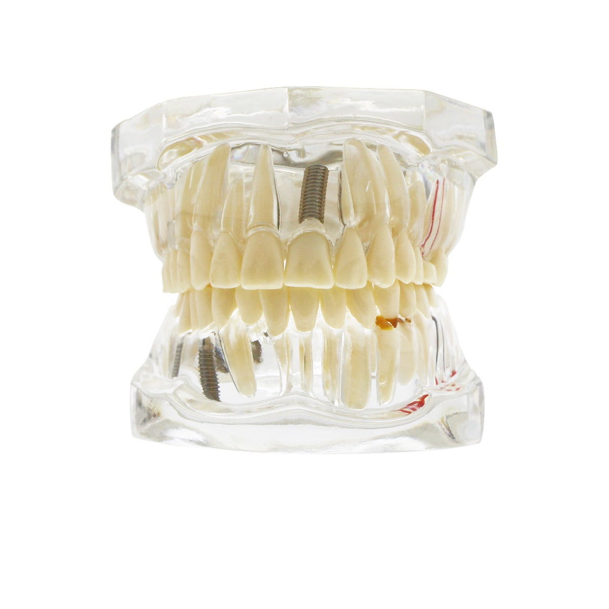 Dental Teeth Model,Transparent Dental Implant Teeth Model Dentist Standard Disease Removable Tooth Pathological Teaching Model