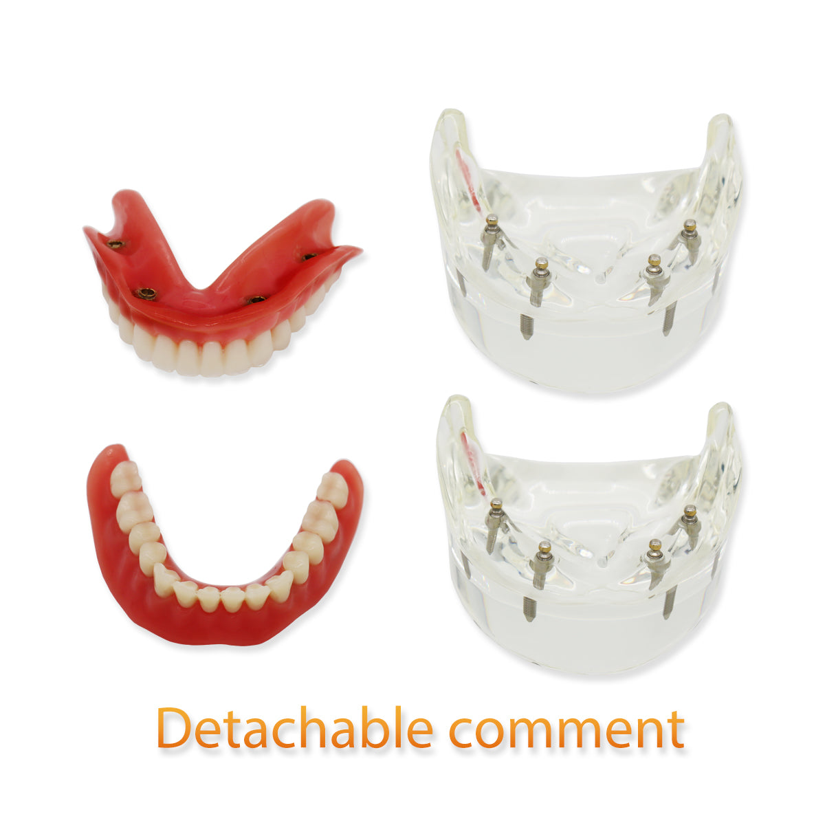 D-DT(Mandibular)Dental Teeth Model,Transparent Dental Implant Teeth Model Dentist Standard Disease Removable Tooth Pathological Teaching Model