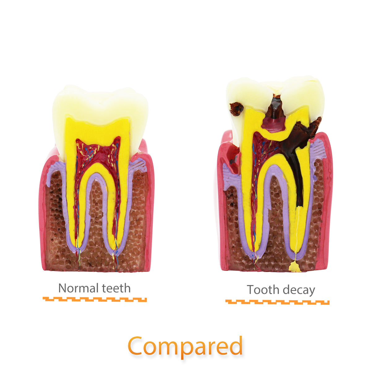 Dental Teeth Model,Transparent Dental Implant Teeth Model Dentist Standard Disease Removable Tooth Pathological Teaching Model（D-CA）