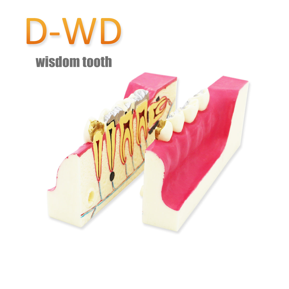 Dental Teeth Model,Transparent Dental Implant Teeth Model Dentist Standard Disease Removable Tooth Pathological Teaching Model(D-WD)