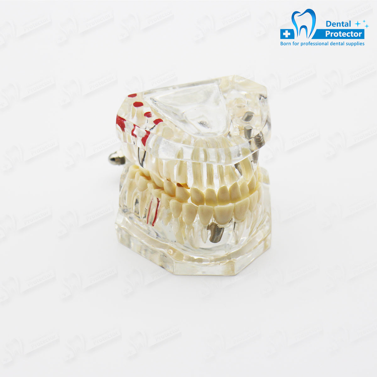 Transparent Disease Teeth Model, YOUYA DENTAL Transparent Dental Implant Teeth Model Dentist Standard Disease Removable Tooth Pathological Teaching Model