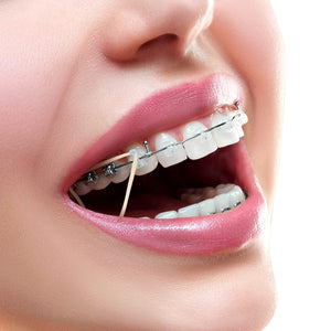 About Rubber Bands for Braces - Biermann Orthodontics